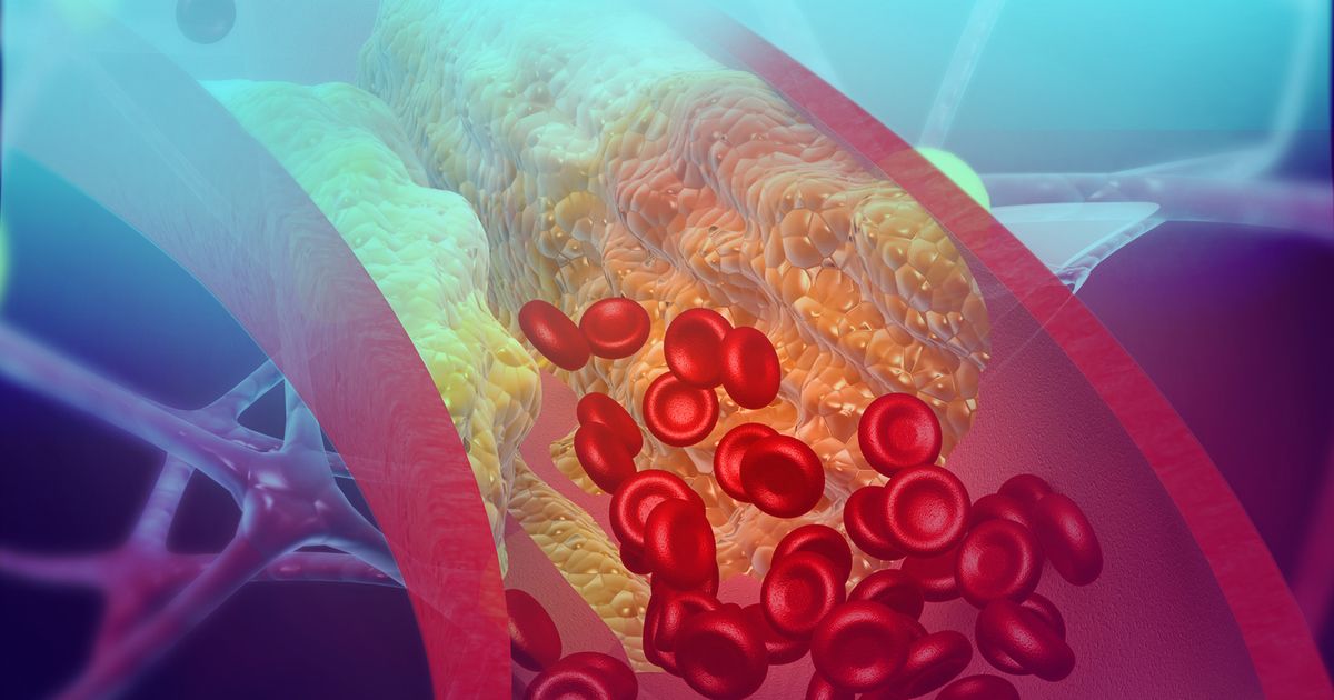 Eli Lilly, Verve Therapeutics to Collaborate on GeneEditing Therapy